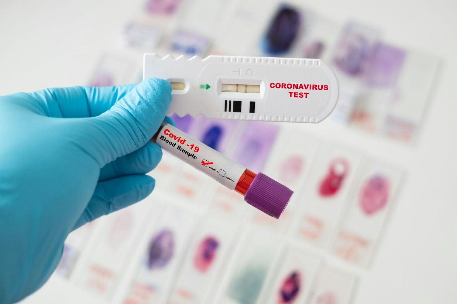 Covid 19 Blood Sample and Rapid Test of Corona Virus in Laboratory Clip